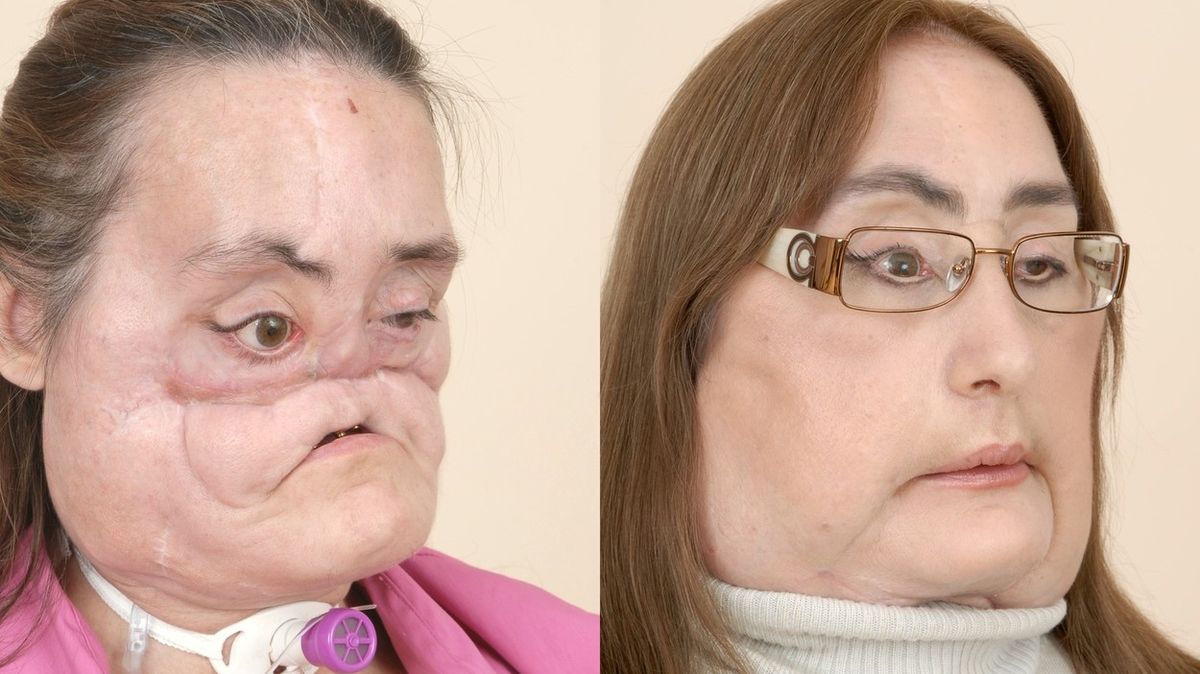 Manžel jí ustřelil obličej, dostala nový. Žena s první transplantovanou tváří v USA zemřela
